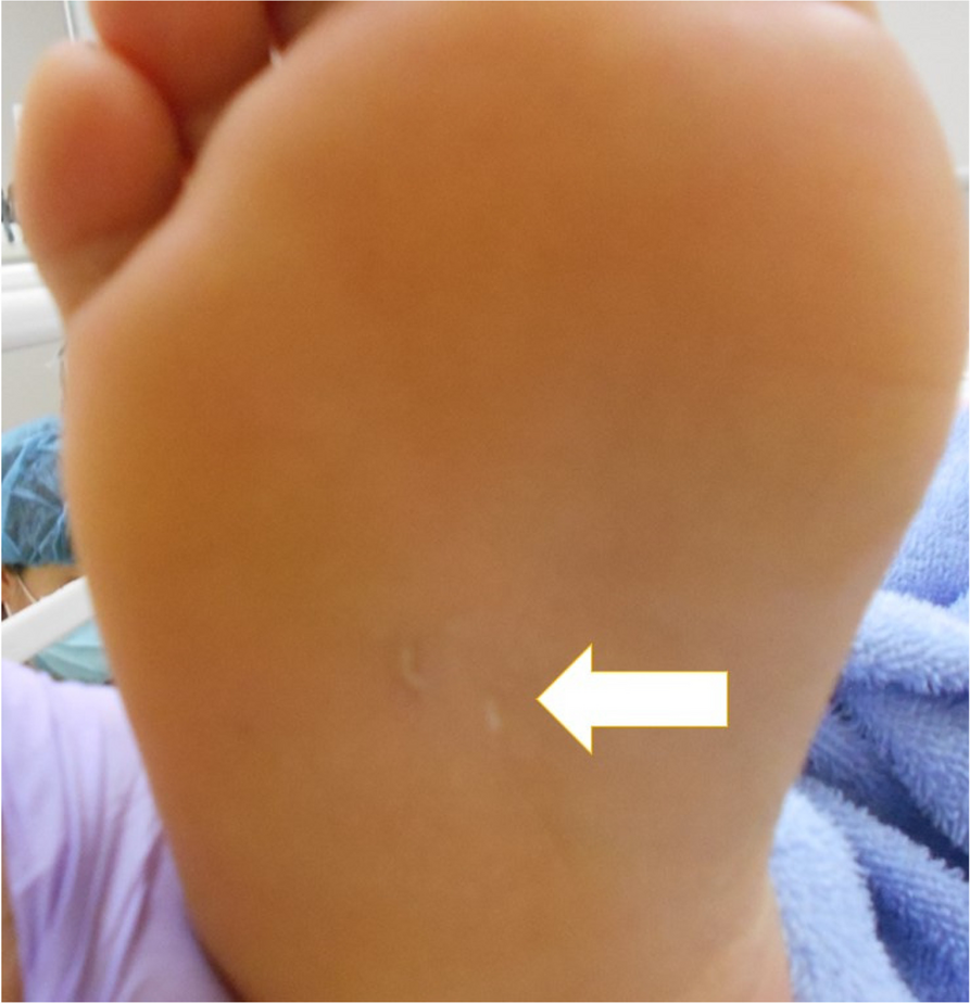 An unexpected case of tetanus in a fully immunized 20-year-old female: a case report