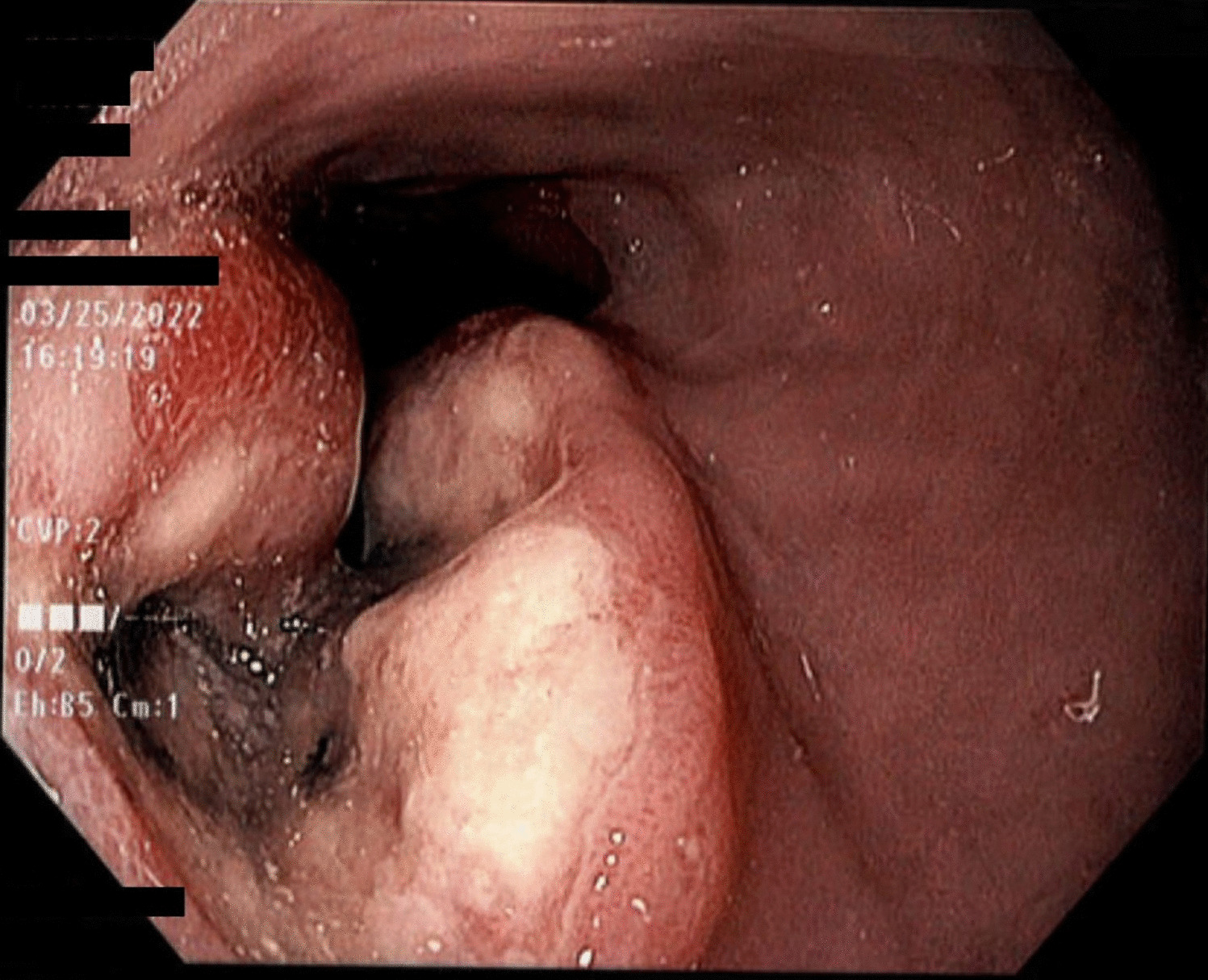 SMARCA4-Deficient Undifferentiated Esophageal Carcinoma: A Clinical Case Series and Literature Review