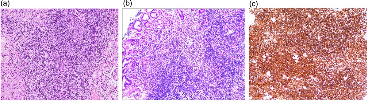 Histopathological staging and differential diagnosis of marginal zone lymphoma of gastric mucosa-associated lymphoid tissue