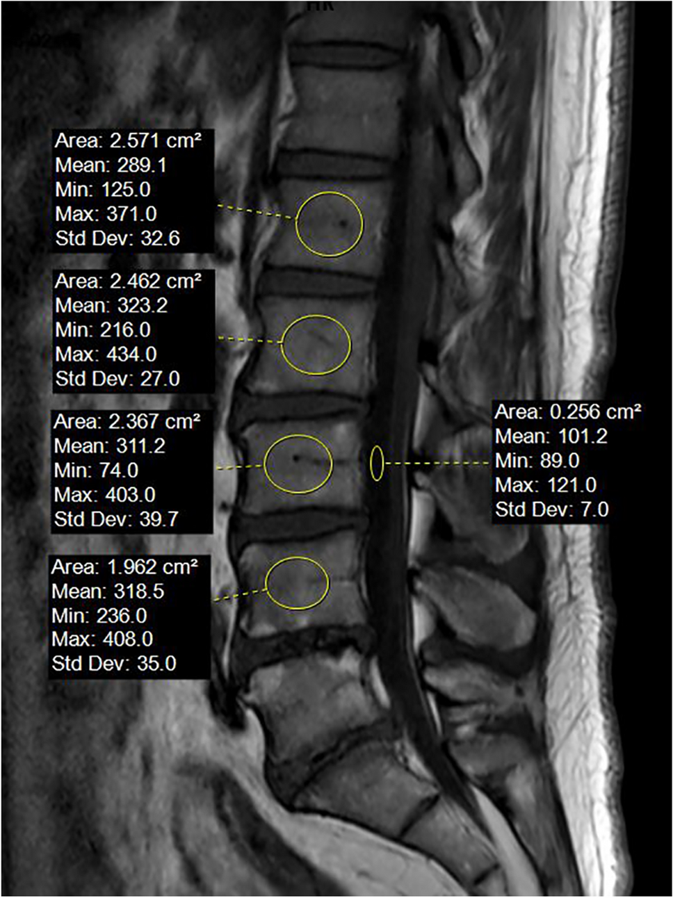 Systematic evaluation of vertebral bone quality score as an opportunistic screening method for BMD in spine surgery patients