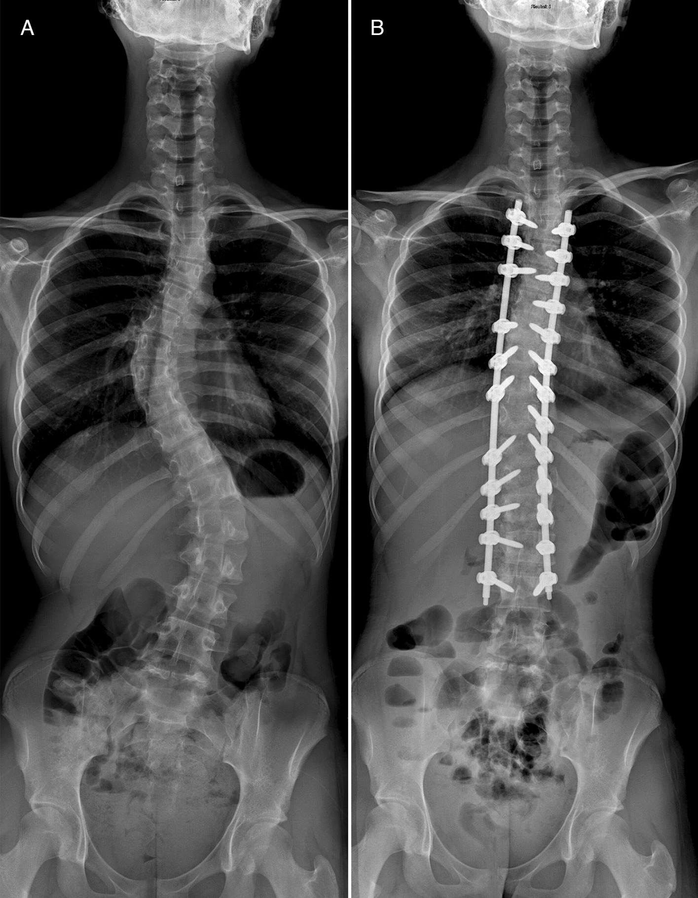 Minimally invasive surgery versus standard posterior approach in the treatment of adolescent idiopathic scoliosis: a 2-year follow-up retrospective study