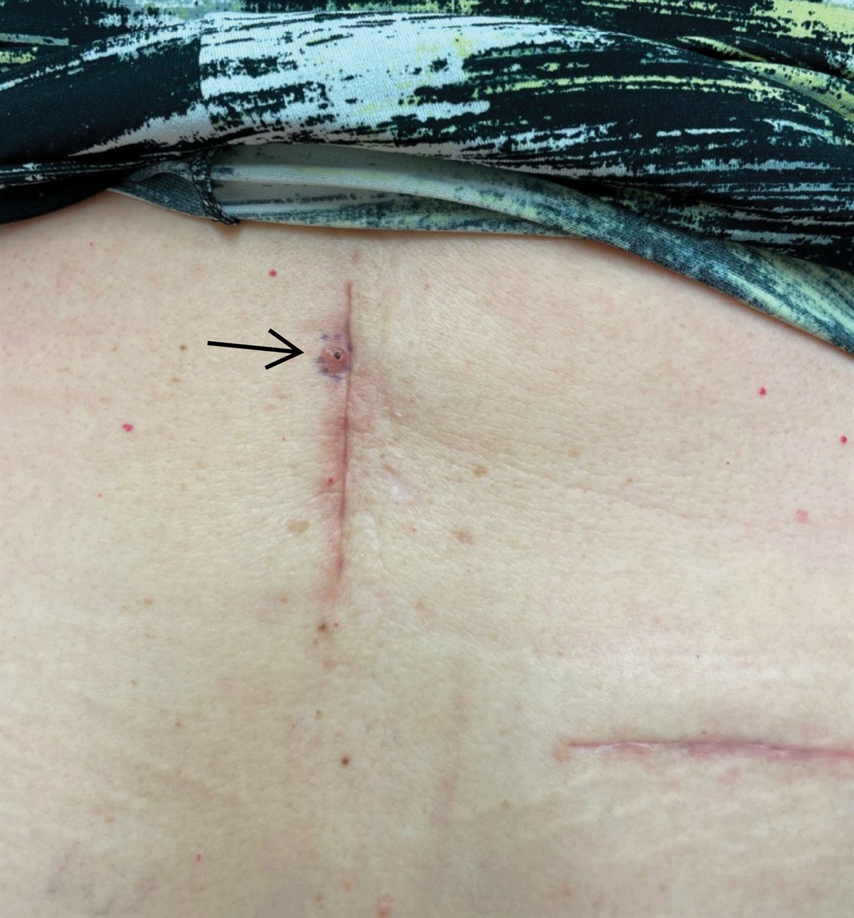 Basal Cell Carcinoma Formation Within A Spinal Cord Stimulator Surgical Scar: A Case Report