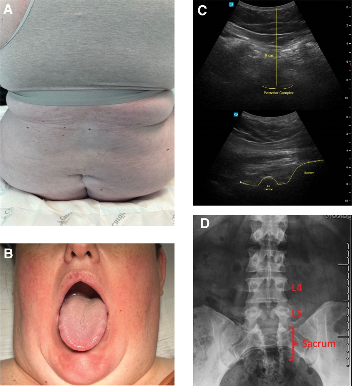 A Case Report of Fluoroscopically Guided Epidural Catheter Placement in a Parturient with History of Tethered Cord, Super-Morbid Obesity, and Risk for Difficult Airway