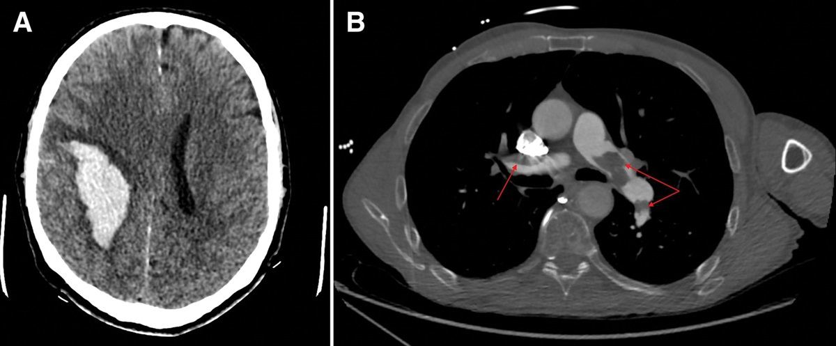 A Case Report of Pulmonary Embolectomy Under Cardiopulmonary Bypass in a Patient with Intracranial Hemorrhage and History of Heparin-Induced Thrombocytopenia
