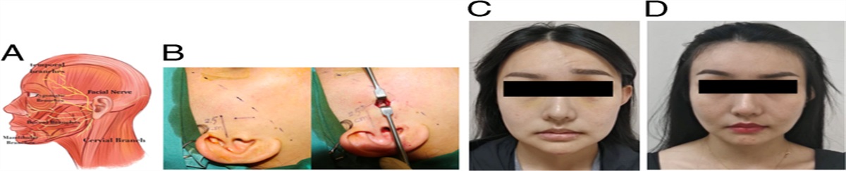 The Clinical Experience in Temporal Branch of Facial Nerve Transient Injury After Reduction Malarplasty