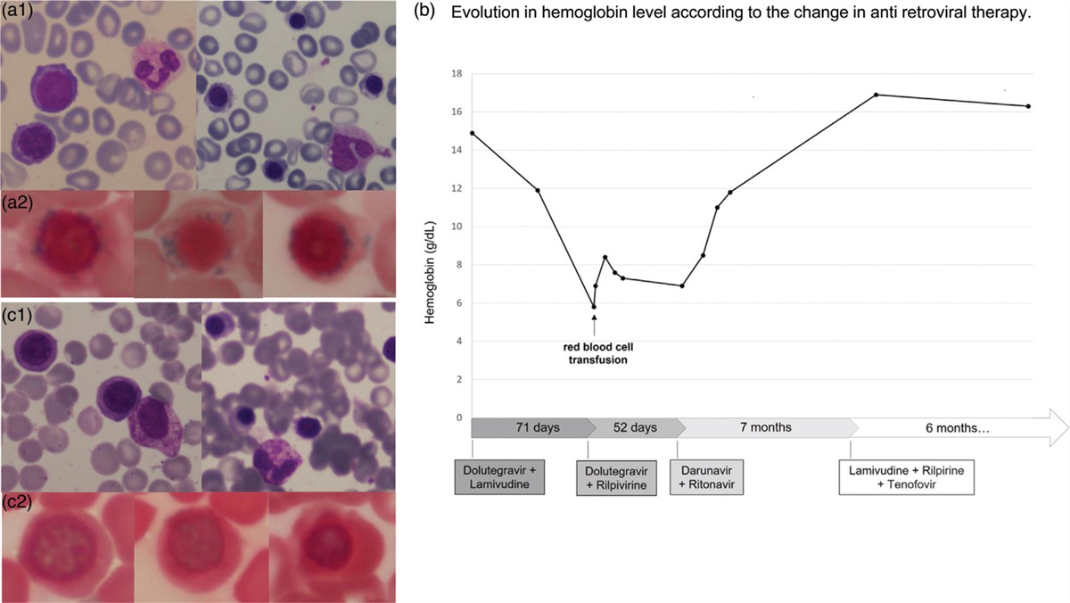 Dolutegravir-induced severe sideroblastic anemia