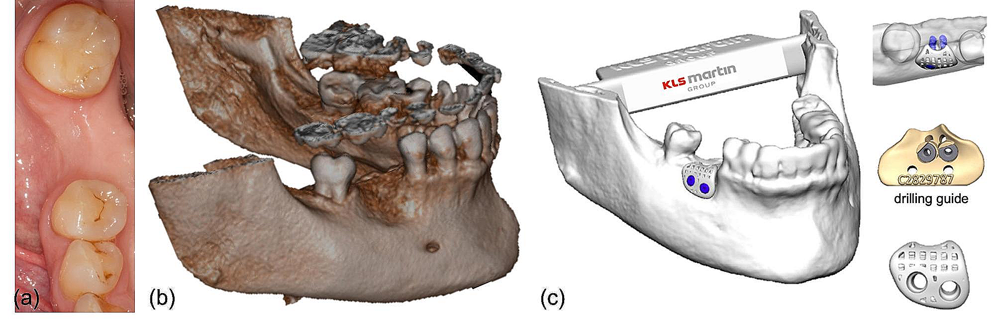 Patient-specific beta-tricalcium phosphate scaffold for customized alveolar ridge augmentation: a case report