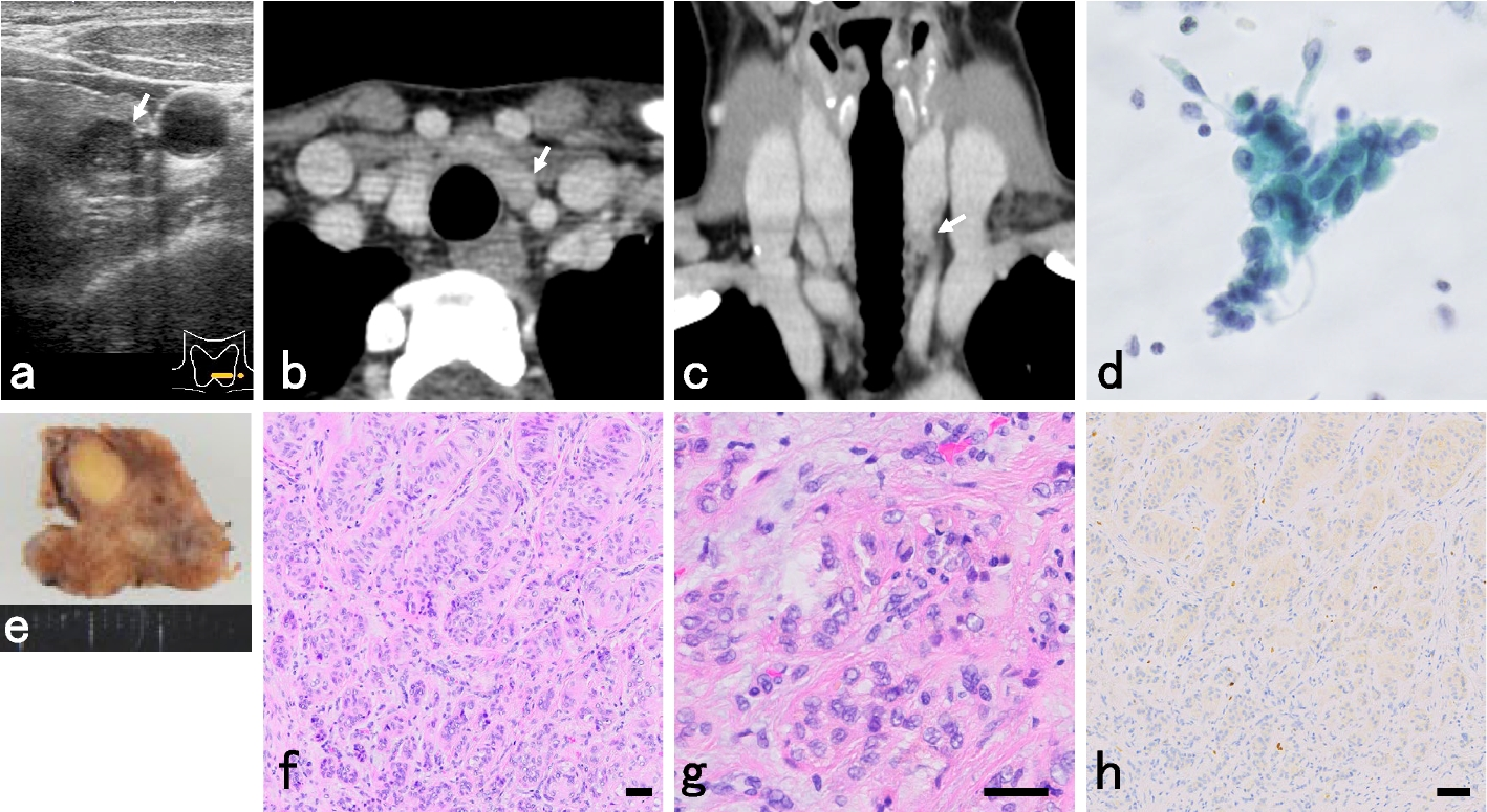 A case of hyalinizing trabecular tumor of the thyroid: diagnostic significance of PAX8-GLIS3 fusion