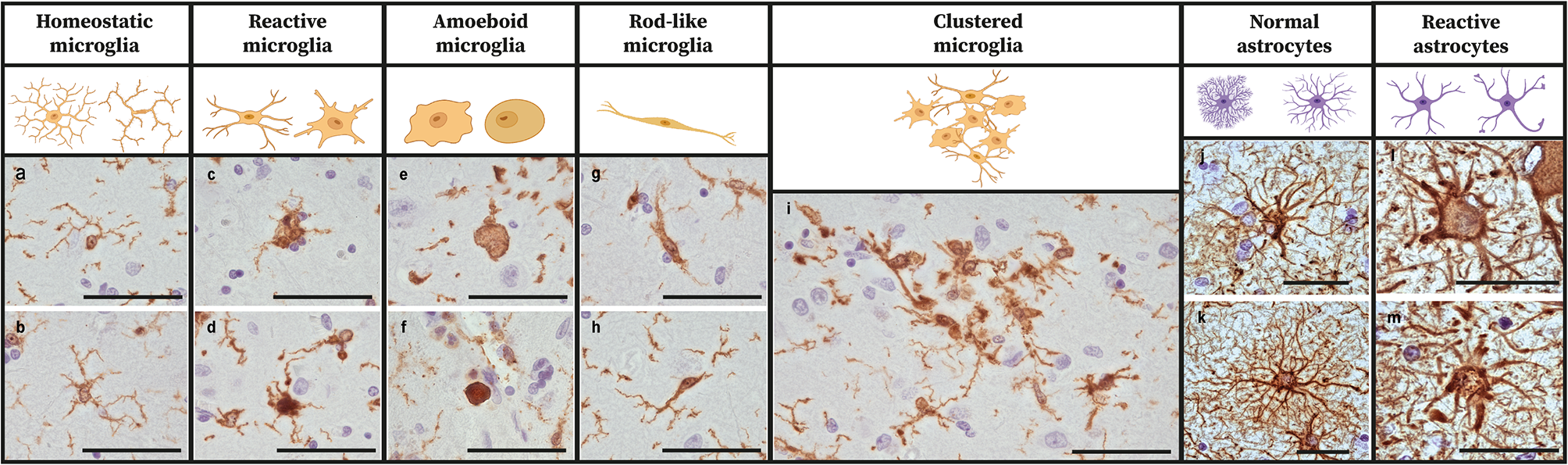 Neuroinflammation is associated with Alzheimer’s disease co-pathology in dementia with Lewy bodies