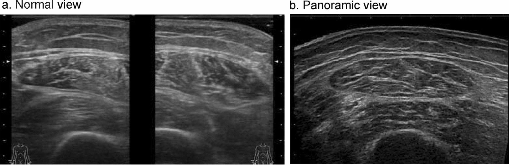 Acute muscle loss assessed using panoramic ultrasound in critically ill adults: a prospective observational study