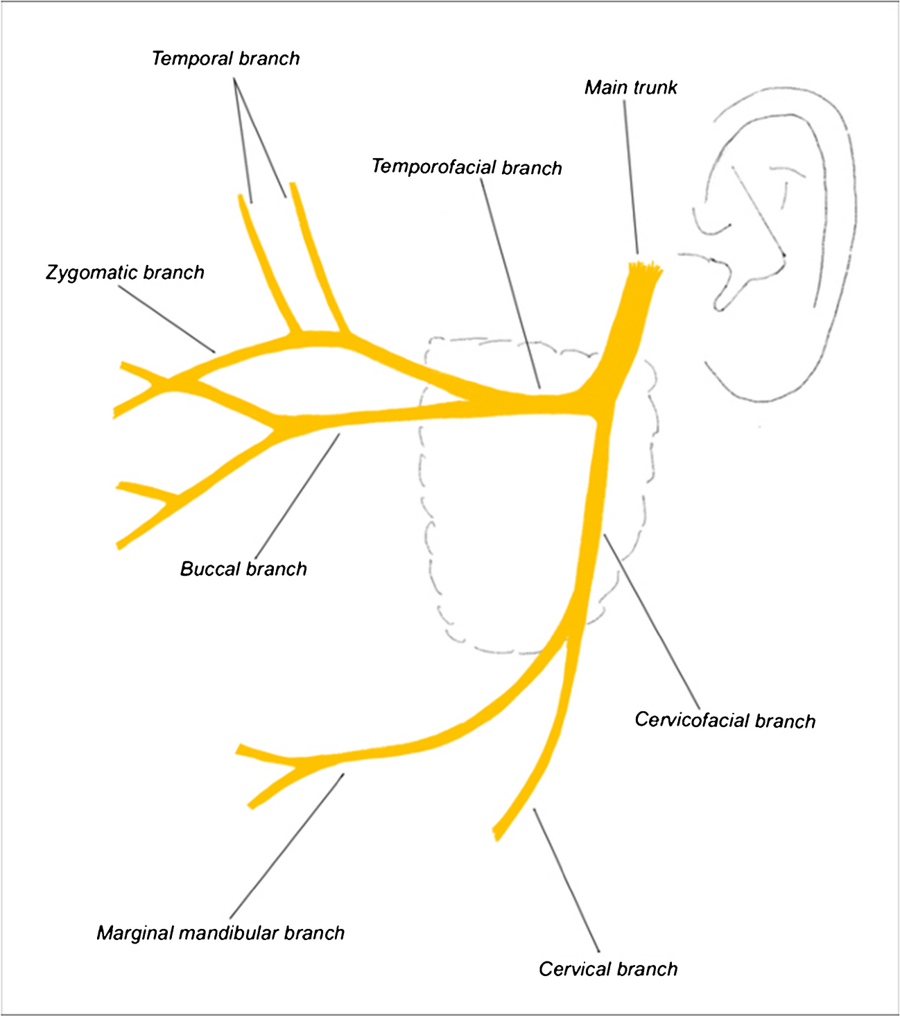 MR-Neurography of the facial nerve in parotid tumors: intra-parotid nerve visualization and surgical correlation