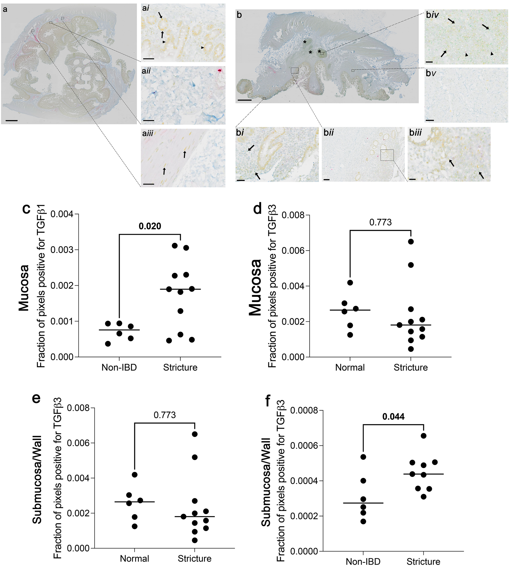 Differential expression of small bowel TGFβ1 and TGFβ3 characterizes intestinal strictures in patients with fibrostenotic Crohn’s disease