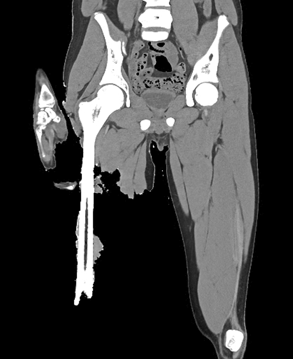Identifying and documenting osseous trauma from shark attacks by post mortem CT examination and autopsy