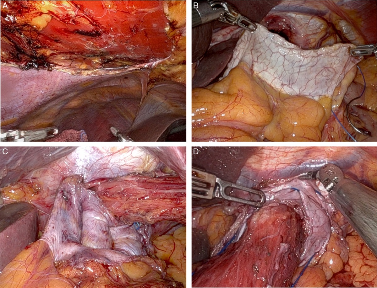 IDEAL Phase 2a Results: Posterior Rectus Sheath Flap for Hiatal Augmentation in Complex Paraesophageal Hernias