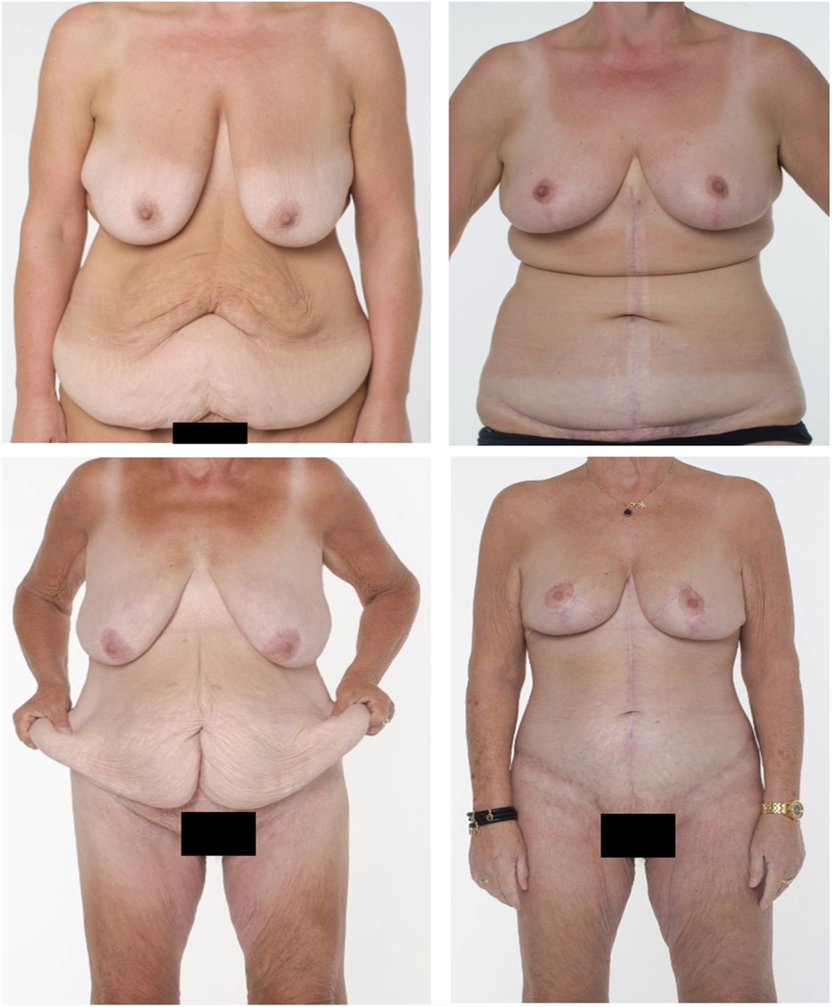 Body Contouring Surgery After Bariatric Surgery Improves Long-Term Health-Related Quality of Life and Satisfaction With Appearance: An International Longitudinal Cohort Study Using the BODY-Q