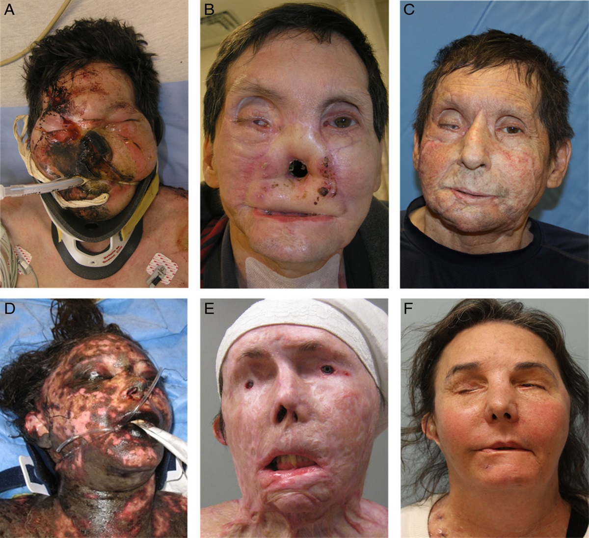Face Transplantation, Social Death, and Bias in Health Care Resource Allocation
