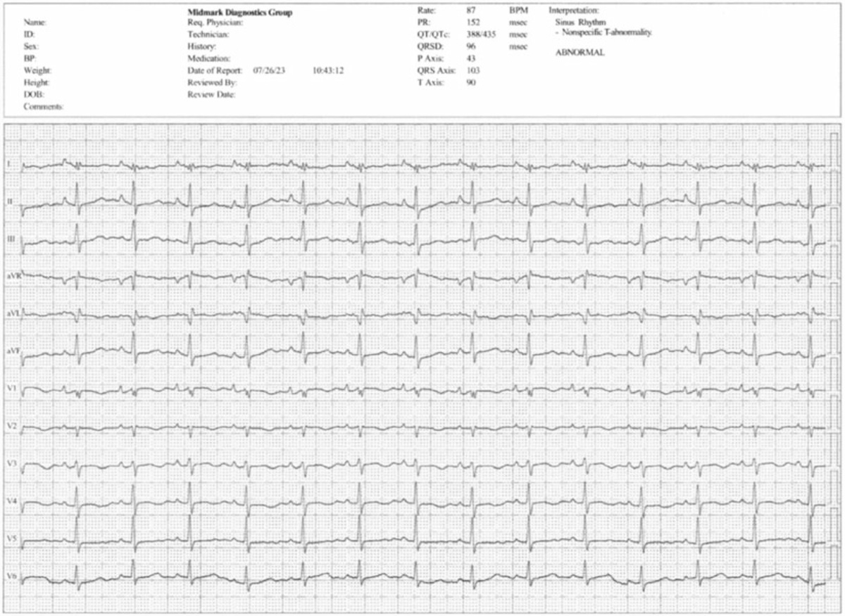 Pharmacological Approach for Symptomatic Nonsustained Ventricular Tachycardia
