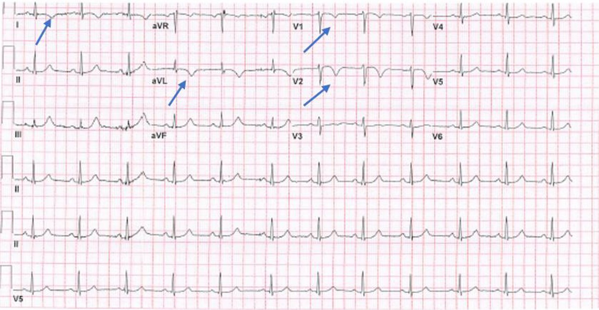A Near Miss in the Emergency Department: Atypical Presentation of Acute Coronary Syndrome