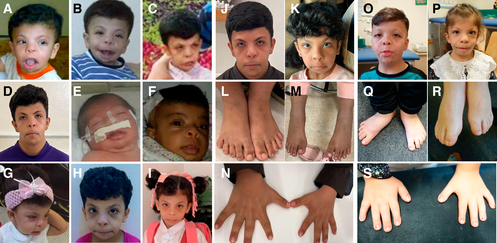 Human ABL1 deficiency syndrome (HADS) is a recognizable syndrome distinct from ABL1-related congenital heart defects and skeletal malformations syndrome