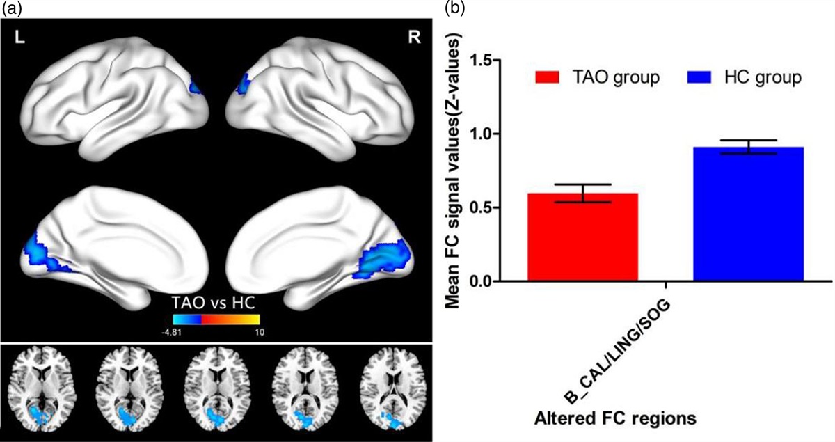 Altered functional connectivity strength of primary visual cortex in subjects with thyroid-associated ophthalmopathy