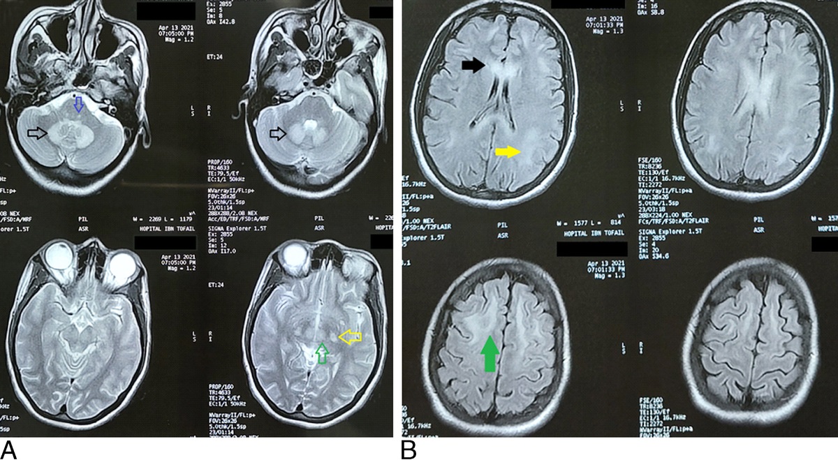 Metronidazole-Induced Encephalopathy With Probable Crohn Encephalitis: A Case Report