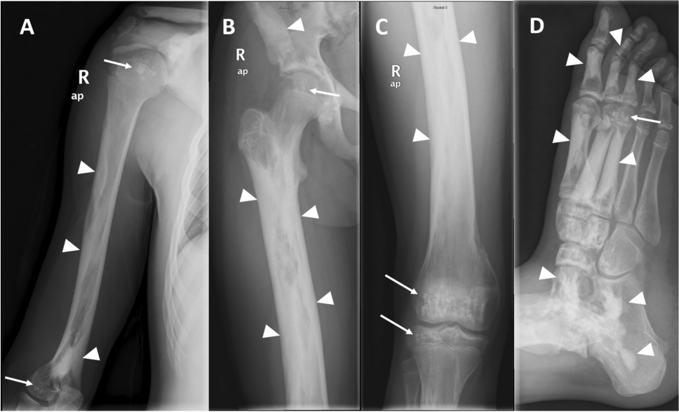 Aneurysmal bone cyst-like changes developed in melorheostosis with epiphyseal osteopoikilosis