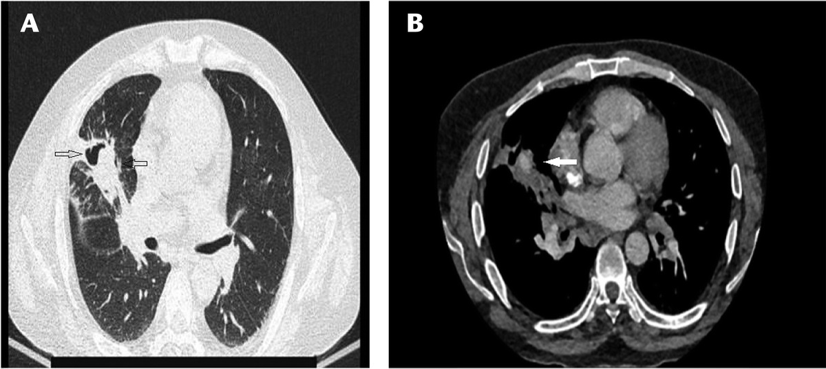 An Atypical Presentation of Pulmonary Mucormycosis