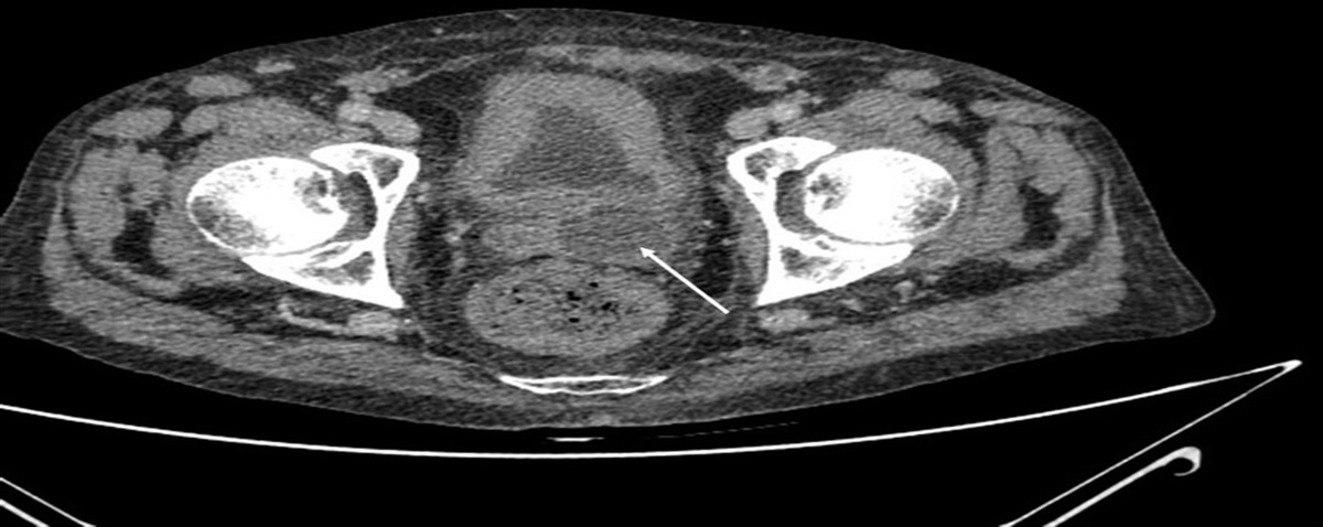 An Elderly Veteran With New Urinary Incontinence and Pelvic Pain