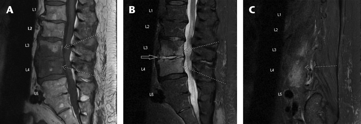 An Unusual Case of Back Pain