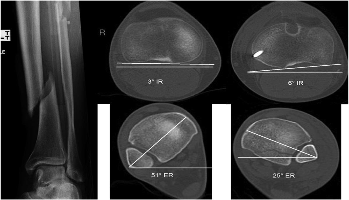 Rotational Malalignment After Intramedullary Nailing of Tibial Shaft Fractures Is Predictable