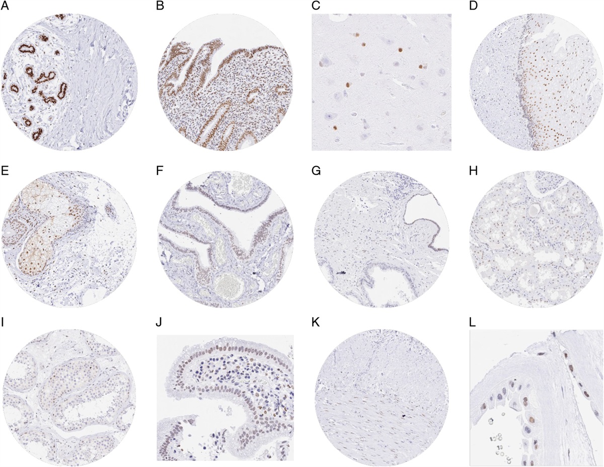 TRPS1 is a Highly Sensitive Marker for Breast Cancer: A Tissue Microarray Study Evaluating More Than 19,000 Tumors From 152 Different Tumor Entities