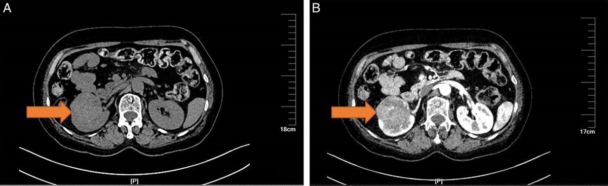 Clinicopathologic and Molecular Characterization of Xanthomatous Giant Cell Renal Cell Carcinomas: Further Support for a Close Morphologic Spectrum to Eosinophilic Solid and Cystic Renal Cell Carcinomas