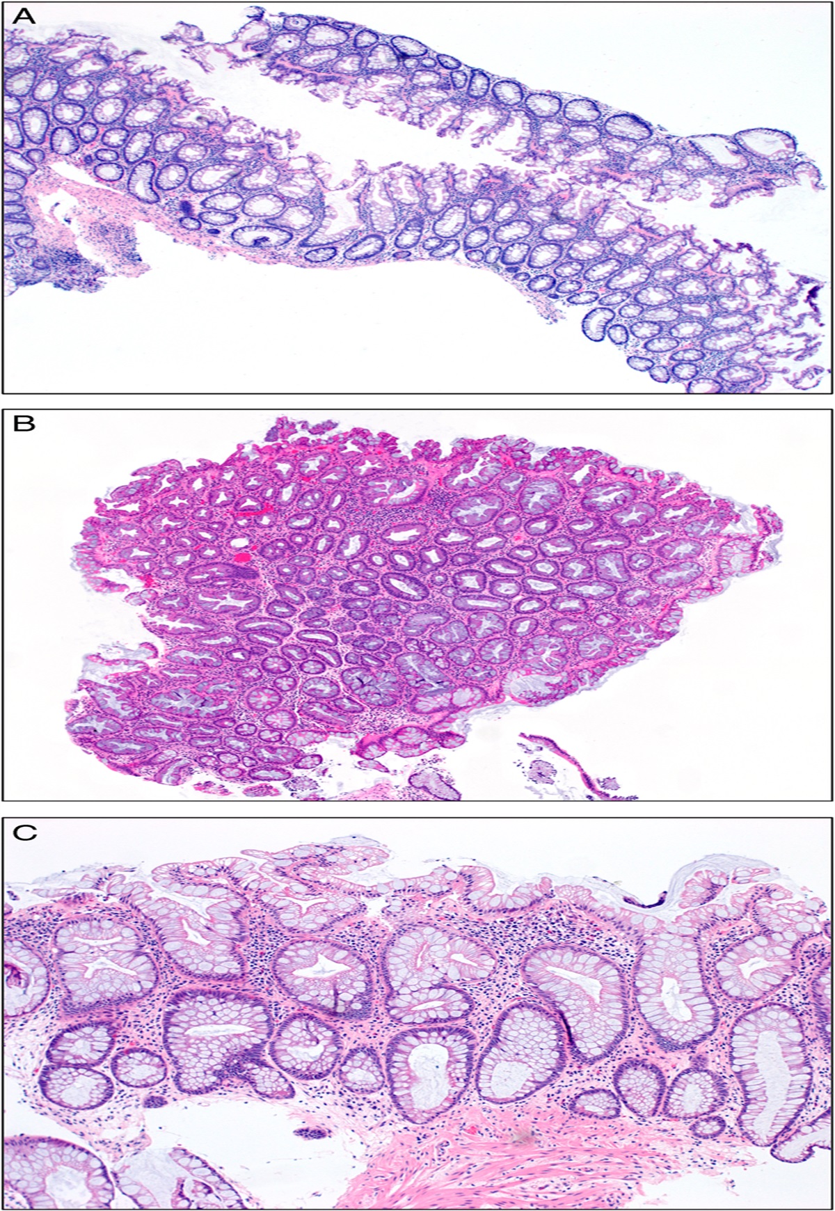 The Development of Serrated Epithelial Change in Ulcerative Colitis is not Significantly Associated With Increased Histologic Inflammation