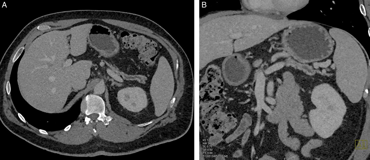 Distinctive Pathology Associated With Focal Stenosis of the Main Pancreatic Duct Secondary to Remote Trauma: A Long-term Complication of Seat Belt Pancreatitis