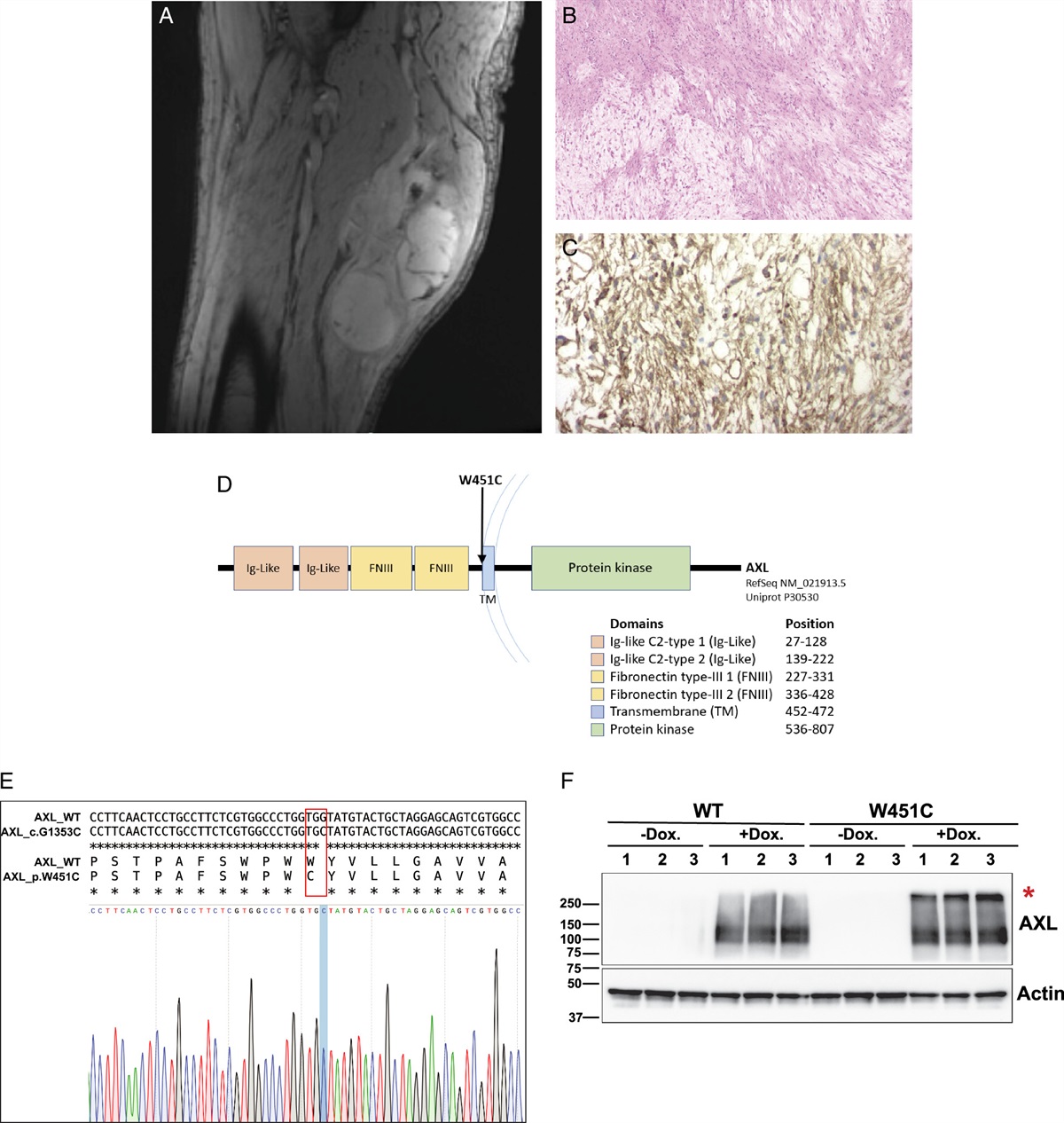 Pan-cancer Genomic Analysis of AXL Mutations Reveals a Novel, Recurrent, Functionally Activating AXL W451C Alteration Specific to Myxofibrosarcoma