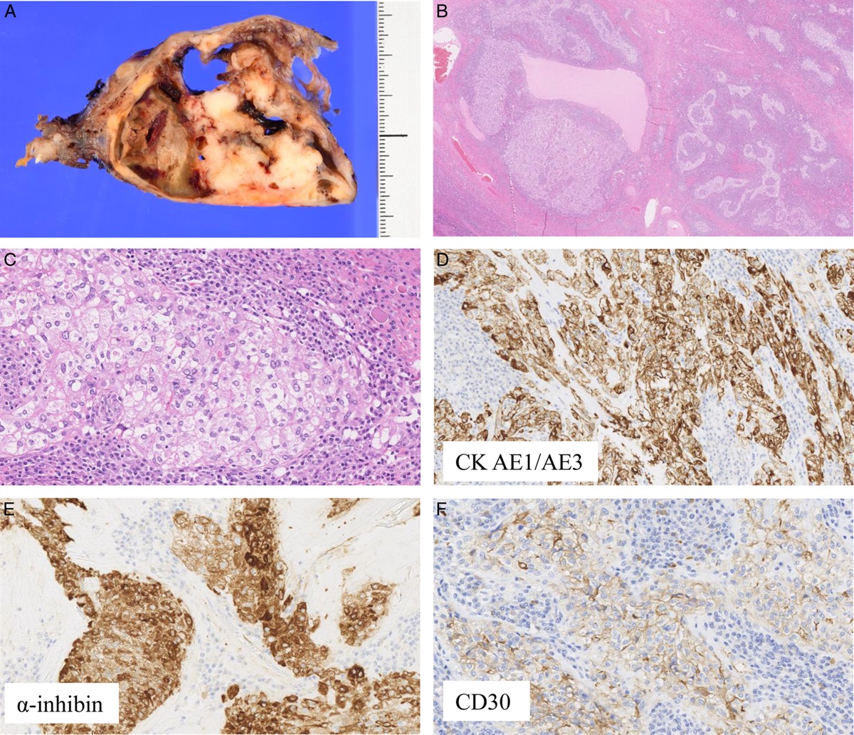 Ovarian Sex Cord Tumor Harboring FUS::CREM Fusion: An Ovarian Counterpart of Inflammatory and Nested Testicular Sex Cord Tumor?