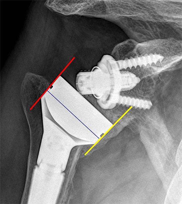 Radiographical magnification of the shoulder region