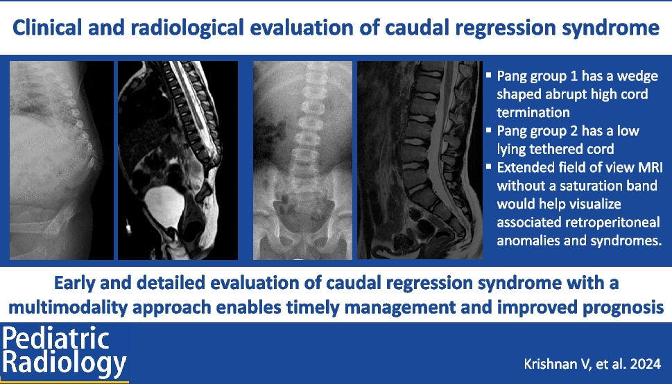 Clinical and radiological evaluation of caudal regression syndrome