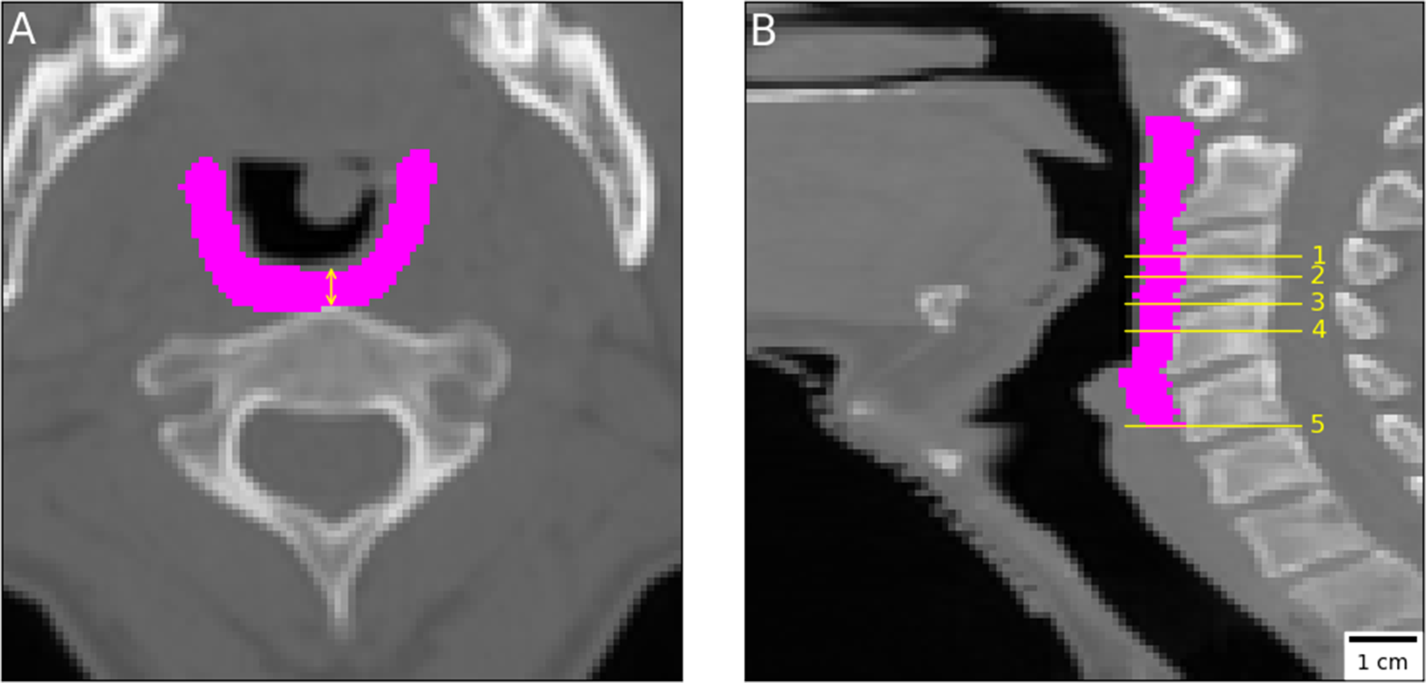 Dysphagia in Head and Neck Radiotherapy: The Influence of Pharyngeal Constrictor Anatomy and Dosimetry