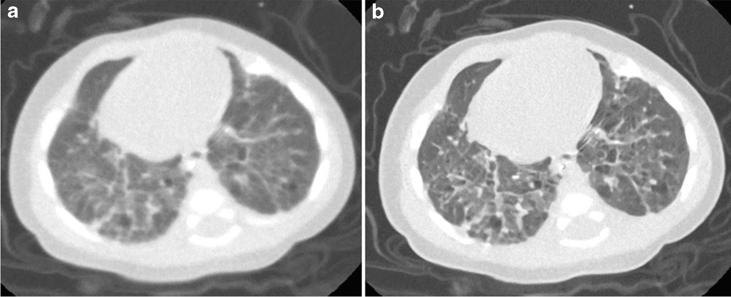 Deep learning reconstruction computed tomography with low-dose imaging