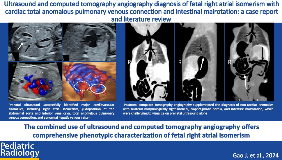 Ultrasound and computed tomography angiography diagnosis of fetal right atrial isomerism with cardiac total anomalous pulmonary venous connection and intestinal malrotation: a case report and literature review