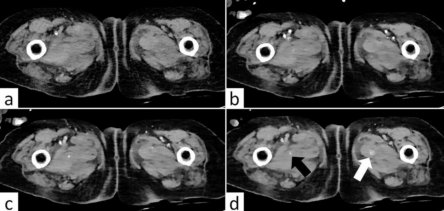 Does delayed phase imaging in CT angiography provide additional information in patients with suspected active bleeding?