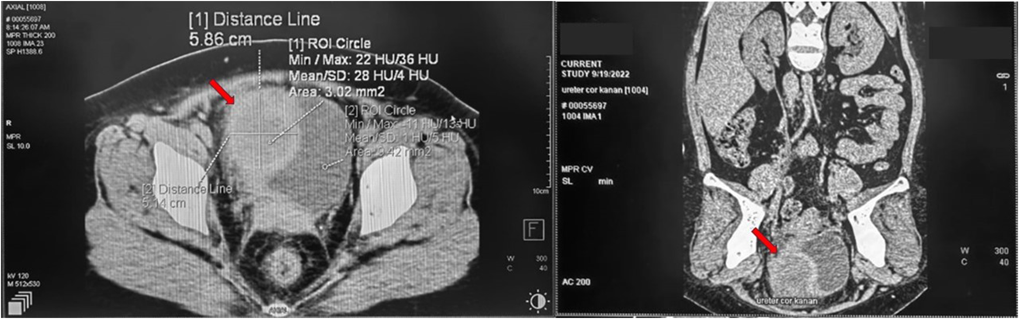 A rare case of spontaneous bladder wall abscess mimicking bladder tumour in young women