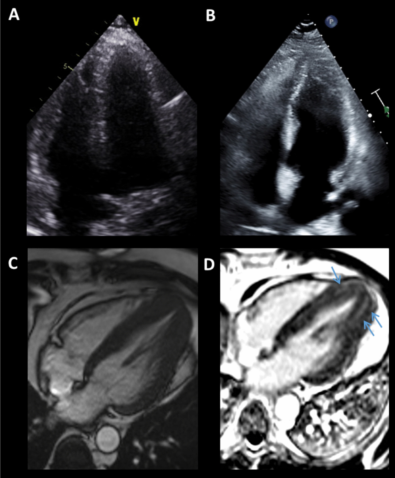 The Role of Multimodality Imaging in Cardiomyopathy