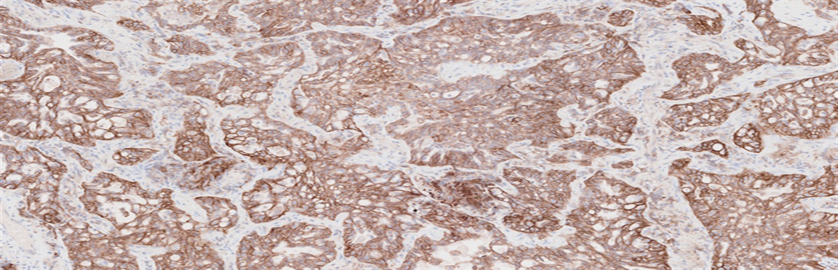 Immunohistochemistry of Lung Cancer Biomarkers