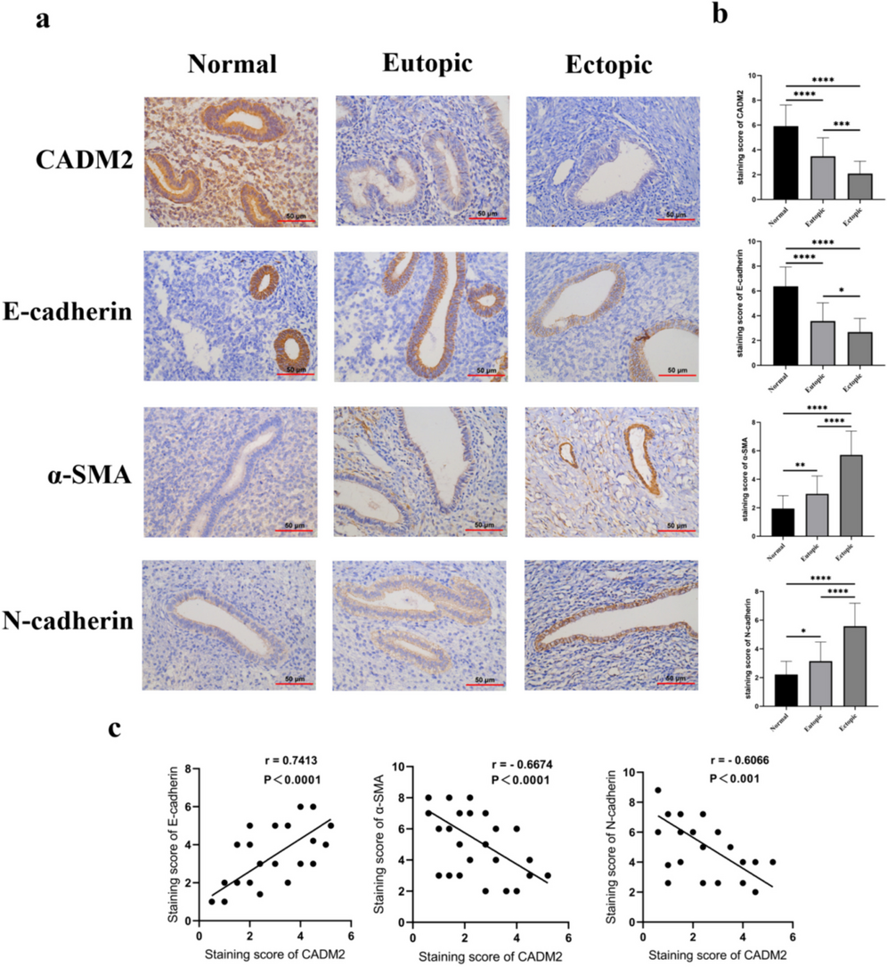 CADM2 participates in endometriosis development by influencing the epithelial-mesenchymal transition