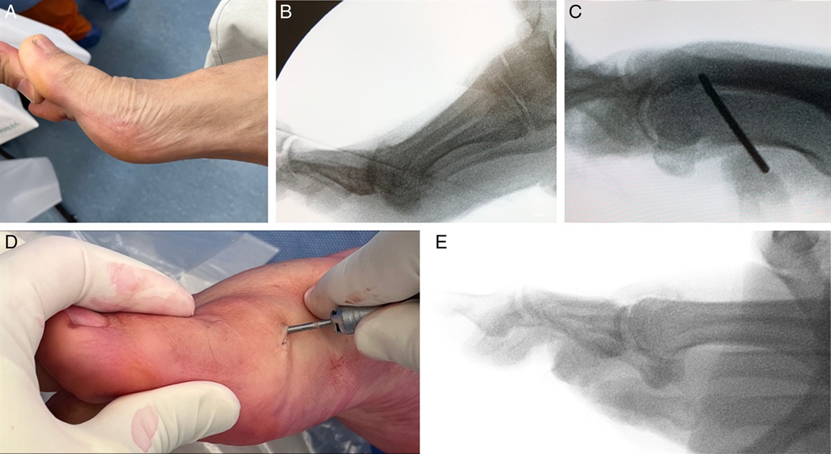 Cheilectomy and the Shortening PelCO for the Treatment of Low-grade Hallux Rigidus