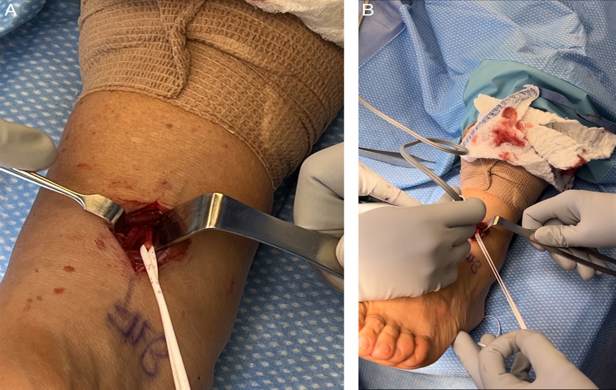 Deep Peroneal Neurectomy for Midfoot Arthritis: A Comprehensive Review, Surgical Technique, and Case Series
