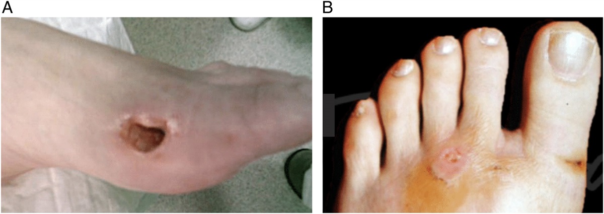 Surgical Insights and Complications of Third-generation Minimally Invasive Chevron Akin Osteotomy for Hallux Valgus