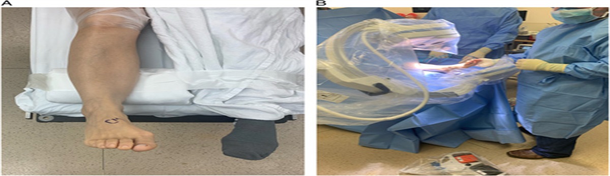 Minimally Invasive Fusion of the First Metatarsophalangeal Joint: A Technical Report